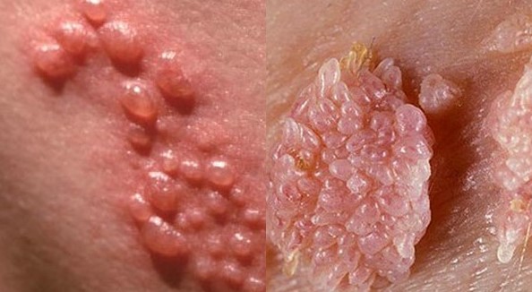 Bệnh sùi mào gà