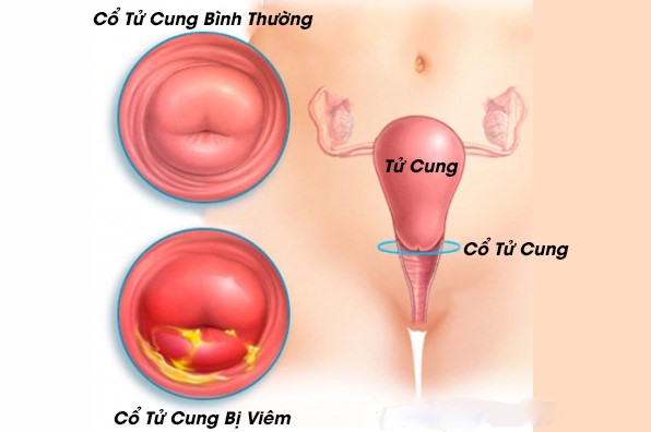 Viêm cổ tử cung