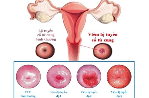 Viêm lộ tuyến cổ tử cung là gì