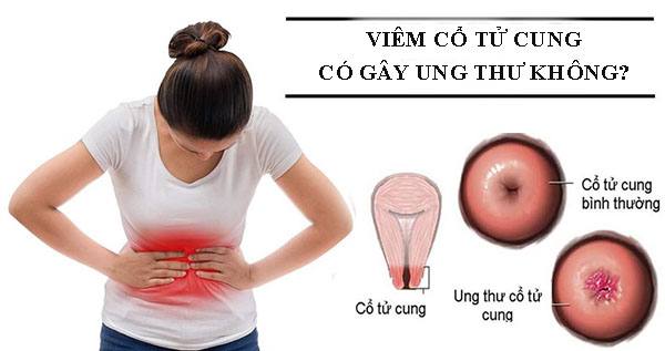 Viêm cổ tử cung có gây ung thư không